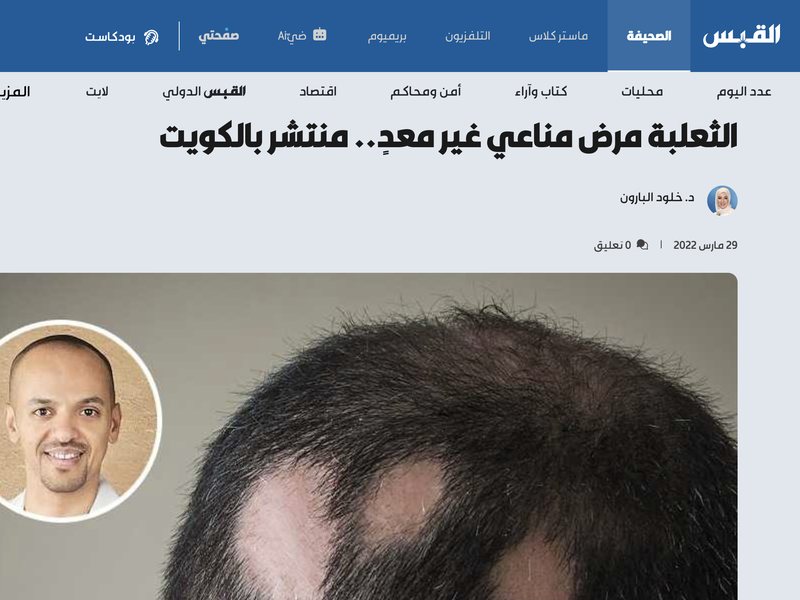 صحيفة القبس — الثعلبة مرض مناعي غير معدٍ.. منتشر بالكويت